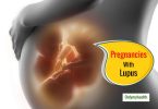 Pregnancy is achievable in women with lupus- Experts