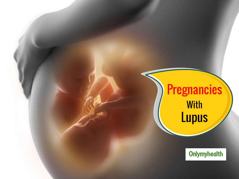 Pregnancy is achievable in women with lupus- Experts